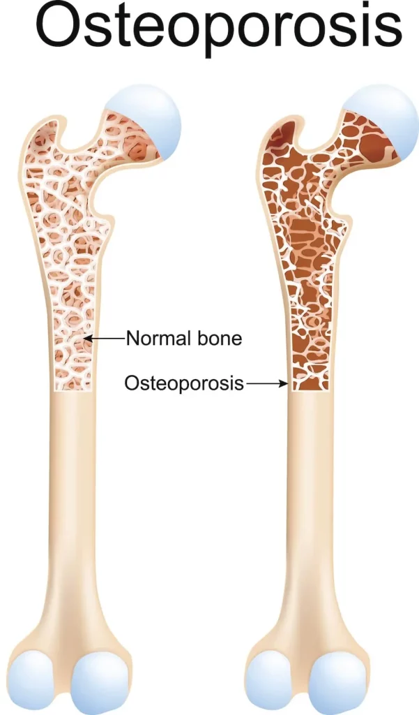 Osteoporosis diagram 54245bc7da807cfa31155992d0ecb8b1