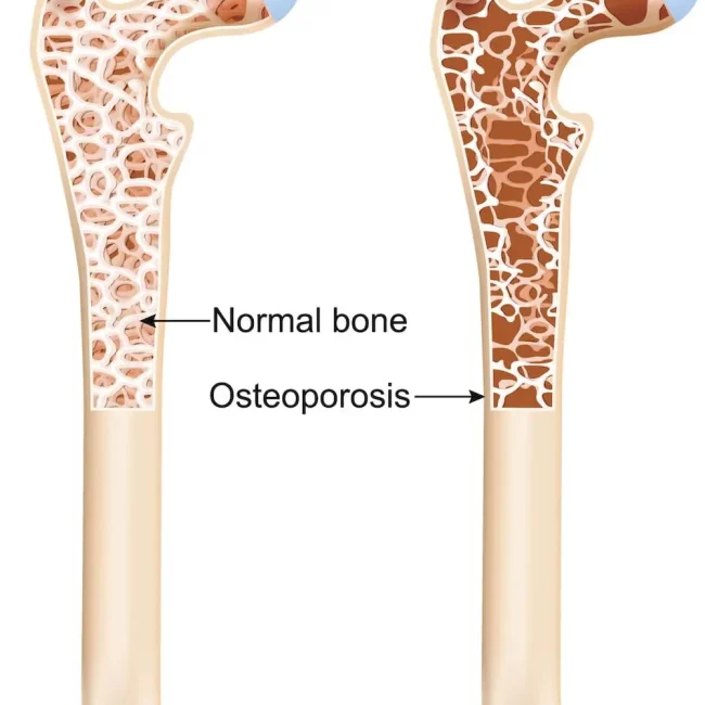 Osteoporosis Bone Strengthening Classes 2 Osteoporosis_diagram-54245bc7da807cfa31155992d0ecb8b1