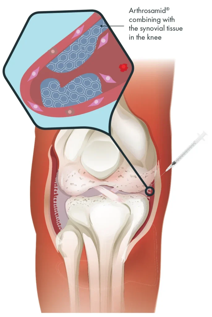 Arthrosamidhowdoesitwork